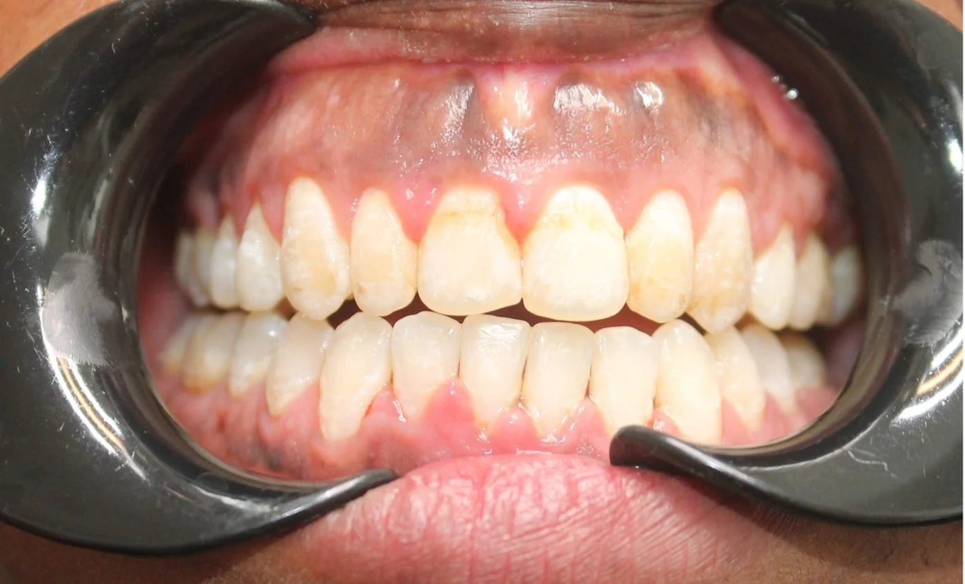 Rakare tänder efter tandreglering hos Göta Dental
