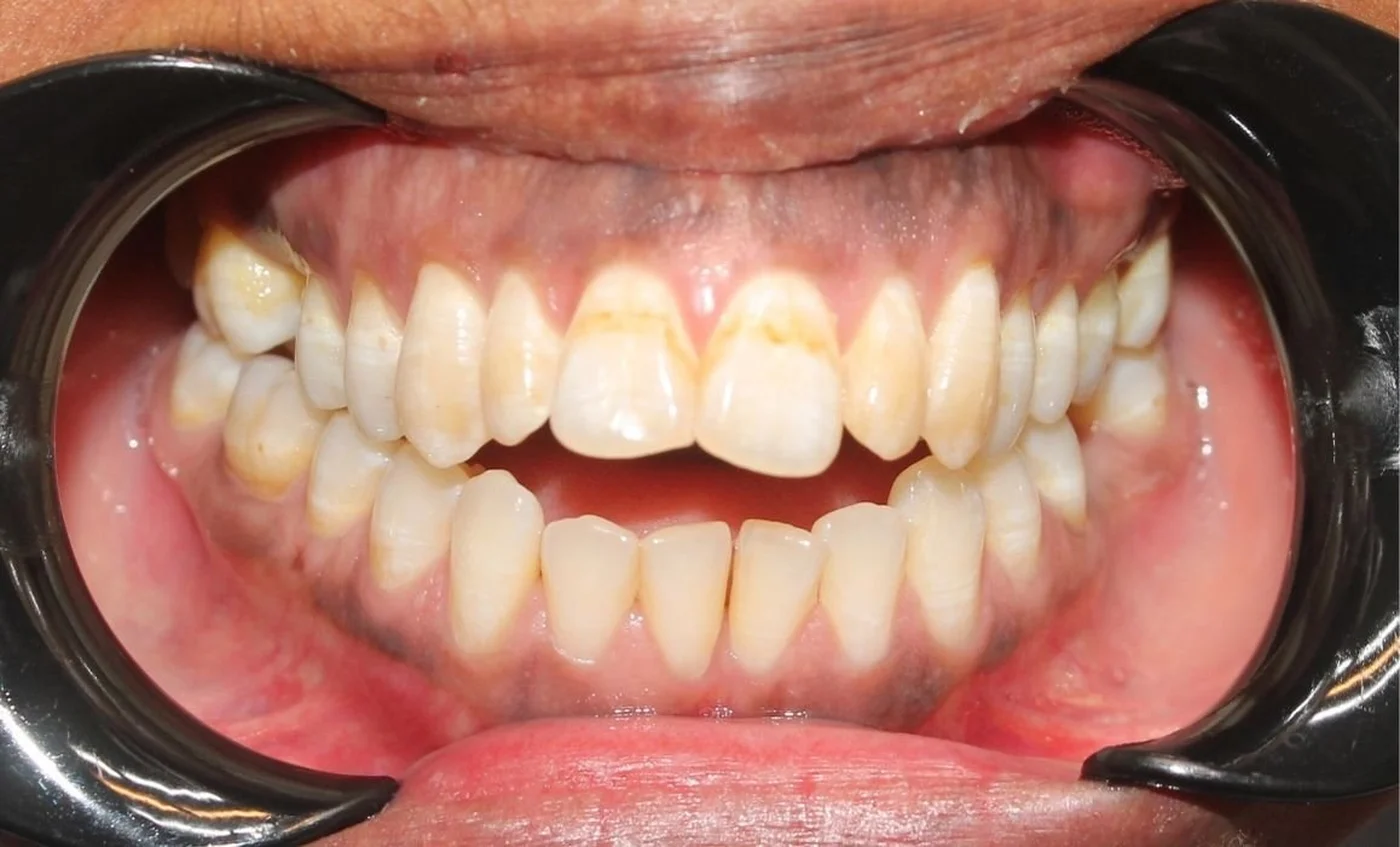 Sneda tänder före behandling hos Göta Dental