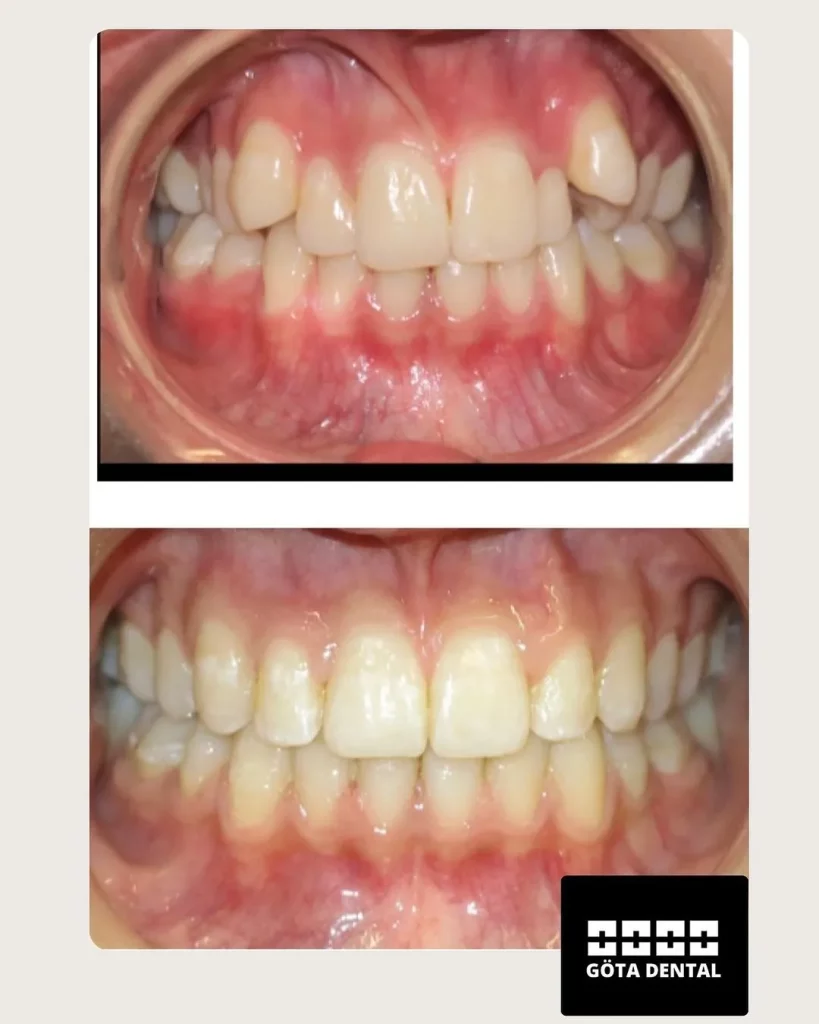 Tandställning metal bracket, klassisk räls