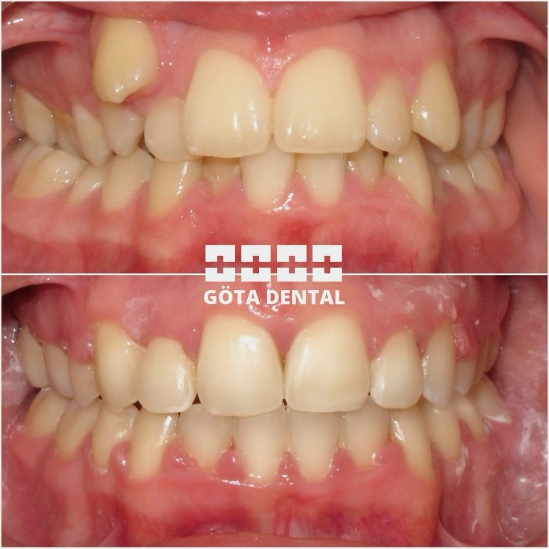 Göta Dental, tandvård Göteborg, tandläkare i Göteborg, tandreglering, ortodonti Göteborg, vuxen ortodonti, estetisk tandvård, tandblekning Göteborg, Philips Zoom, osynlig tandställning, keramiska tandställningar, Aligners, Jilah Qaljaee, specialisttandläkare, professionell tandhygien, tandhygienist Göteborg, tandhälsa, munvård, leende makeover, skonsam tandvård, modern tandvård, tandställning vuxna, estetiska fyllningar, tandundersökning, tandvårdsklinik, tandimplantat, munhygien, tandvårdstjänster, tandröntgen, före och efter tandvård, individuell tandvård, tandvårdsbehandling, tandhälsokontroll, tandvårdsrådgivning, munhälsorådgivning, förebyggande tandvård, kvalitetstandvård, tandvårdstips, tandvårdsteknik, avancerad tandvård, tandvårdspecialist, tandblekningskit, hemmatandblekning, tandvårdsprodukter, estetisk ortodonti, ortodontisk behandling, tandläkarklinik, tandvårdserbjudanden, tandvårdsrabatter, tandvårdskampanjer