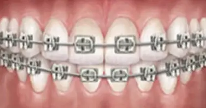 Fast tandställning (metall) – Göta Dental