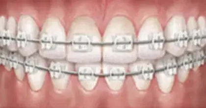 Keramisk tandställning – Göta Dental