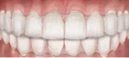Aligners – osynlig tandställning med skenor