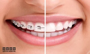 Hur fungerar osynlig tandställning jämfört med traditionell tandställning_