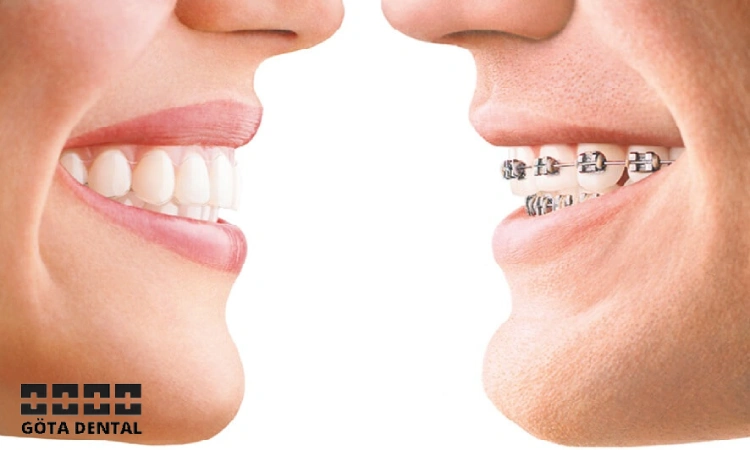 Invisalign vs metallfästen