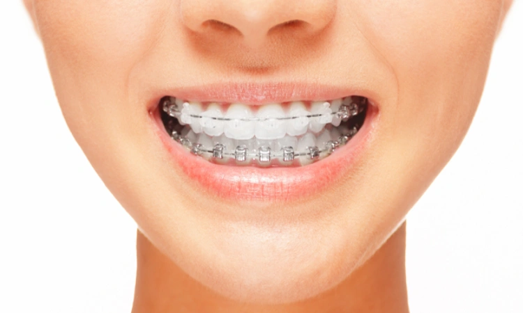 Keramisk tandstallning