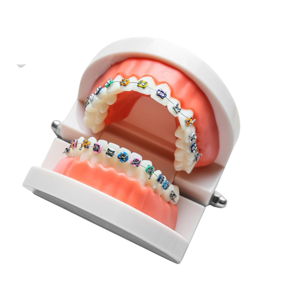 Tandställning, tandreglering, pris Göteborg