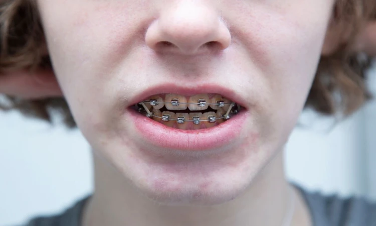 öppet bett behandling med Invisalign