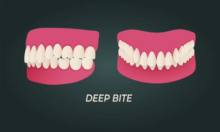 tandreglering djupt bett