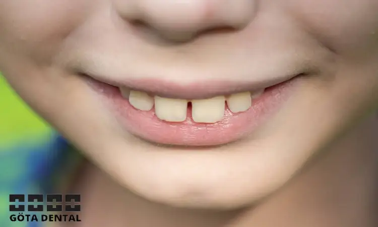 Behandling av överbett hos barn