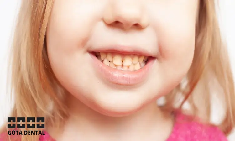 Behandling av överbett