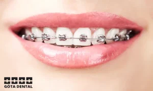 Metallfästen och tandbågar