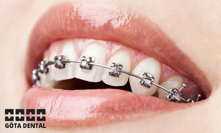 understanding metal braces