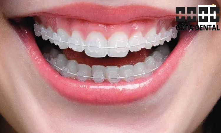 Vit tandställning pris