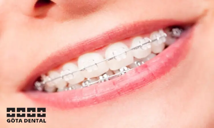 fördelar med vit tandställning