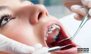 hur går aligner behandling steg för steg till