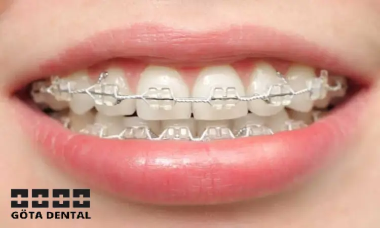 kan vit tandställning missfärgas