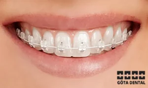 kostnad för vit tandställning