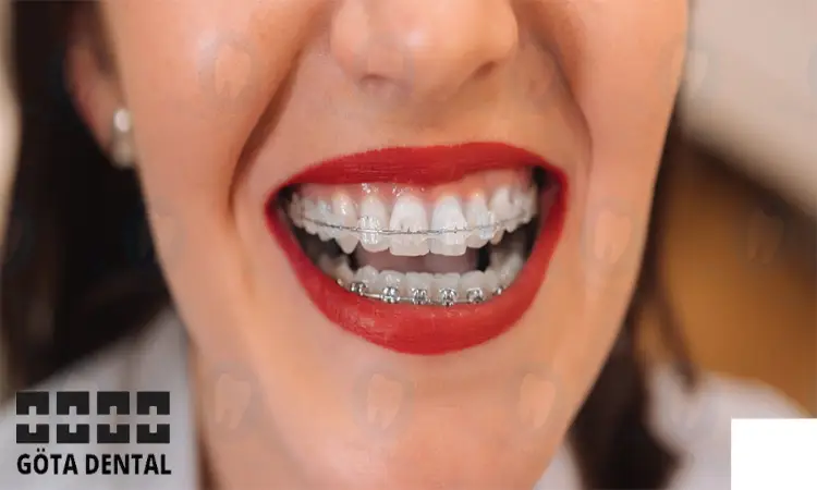 nackdelar med vit tandställning