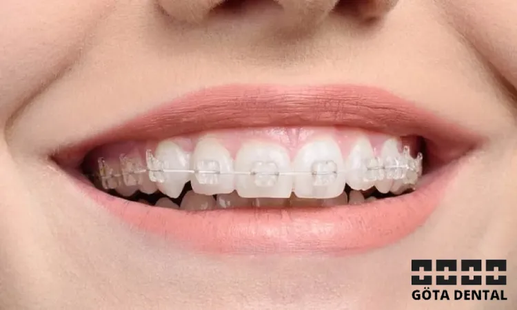 vit tandställning Göteborg