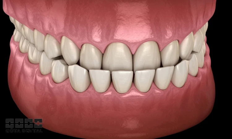 orsaker till underbett hos barn