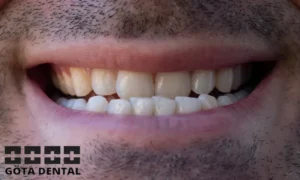 orsaker till underbett hos vuxna