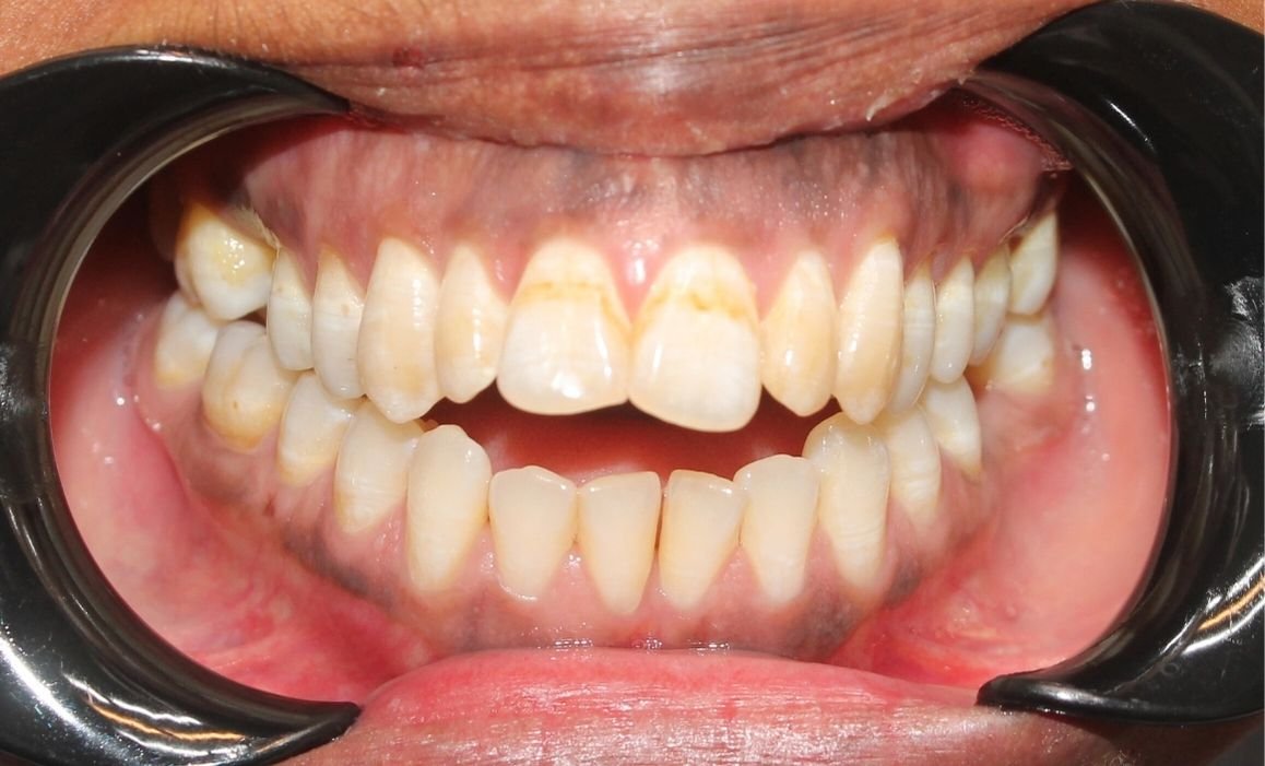 Före tandreglering – gluggar mellan framtänder