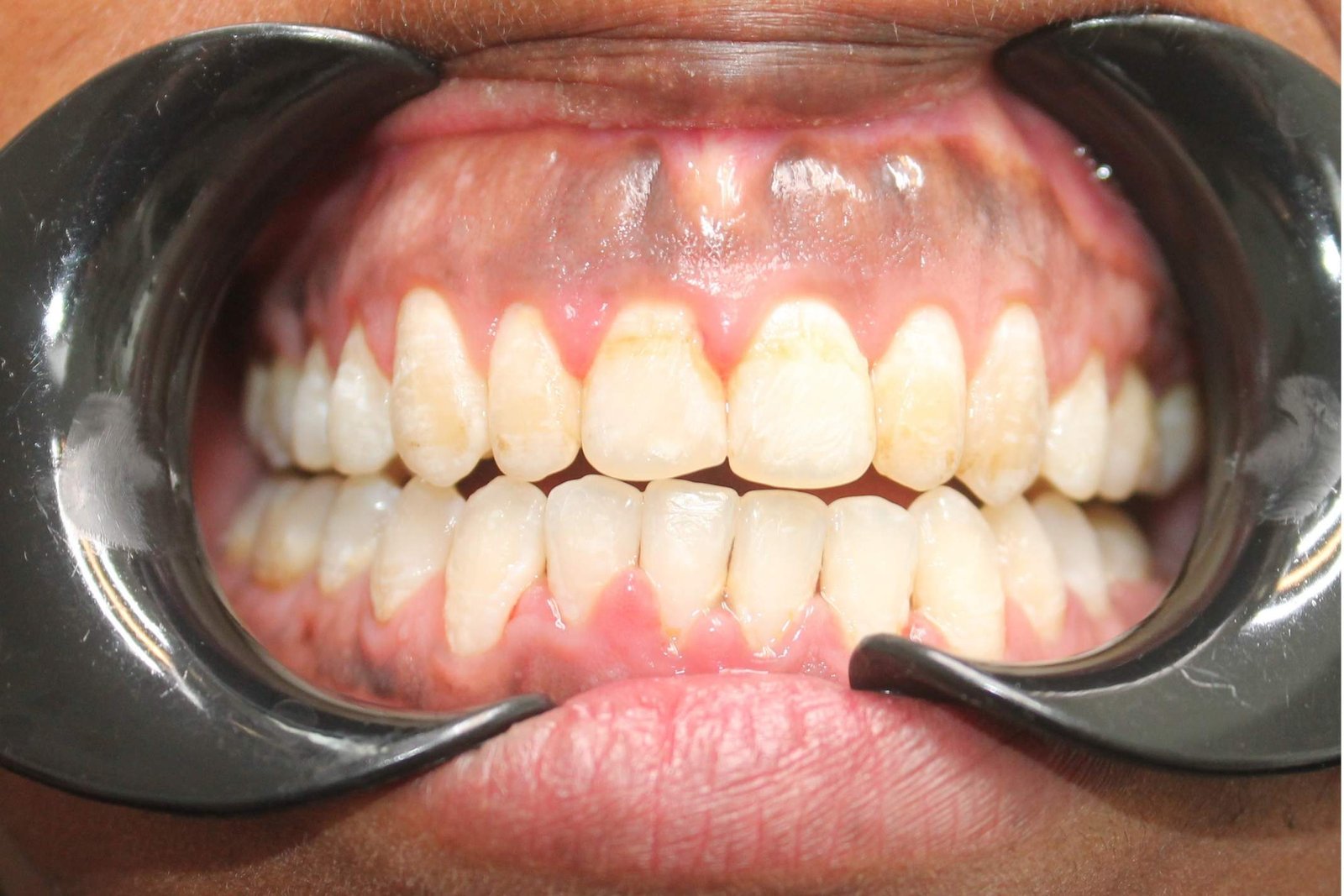 Efter tandreglering med aligners – stängda gluggar