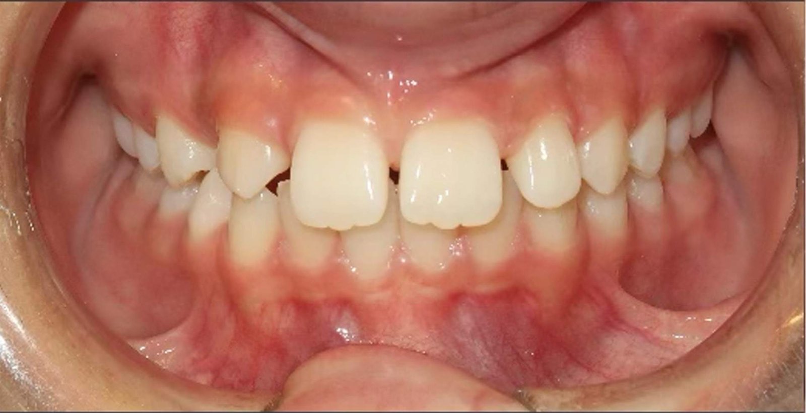 Före tandreglering hos Göta Dental – trångställda framtänder