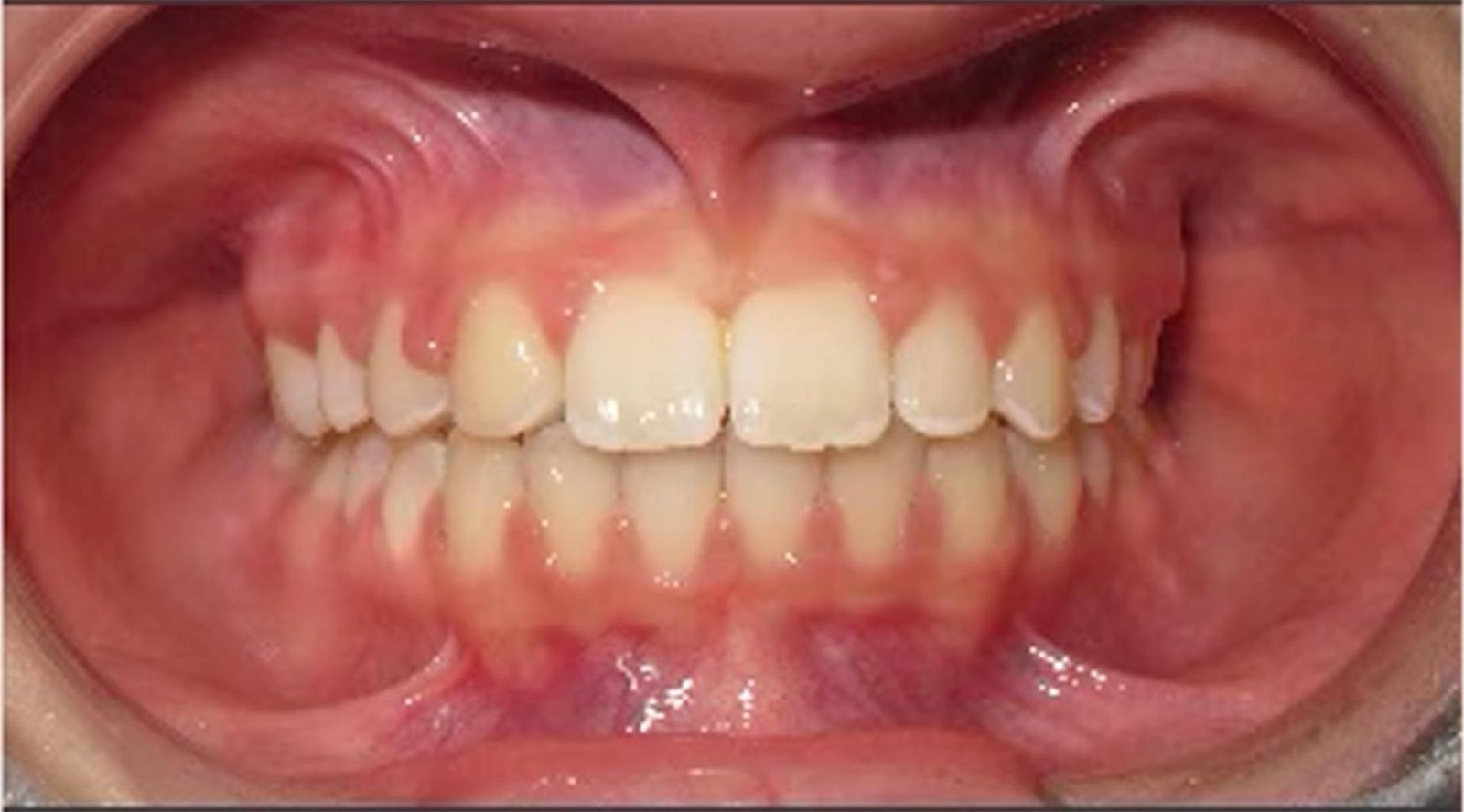 Efter tandreglering – stängda gluggar mellan tänderna