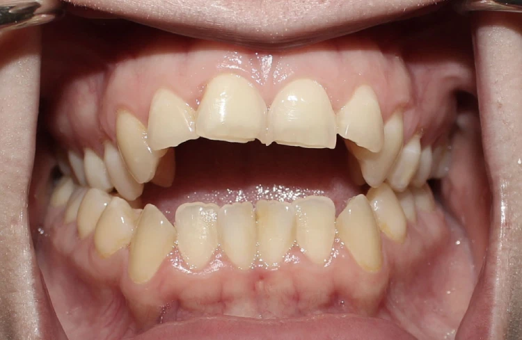 När ska barn gå till ortodontist