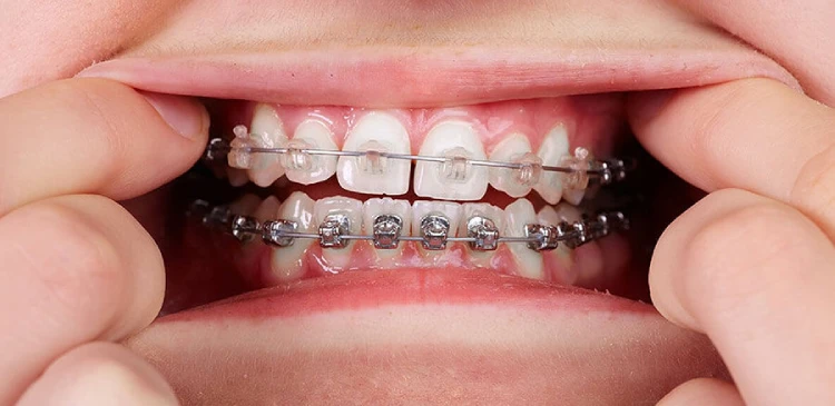 när ska man börja med metall tandställning för barn