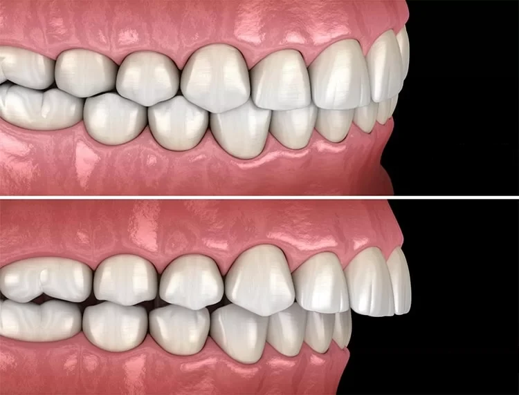 tandreglering för barn