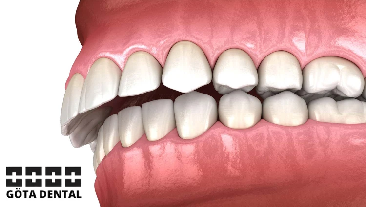 tandreglering för djupt bett i Göteborg