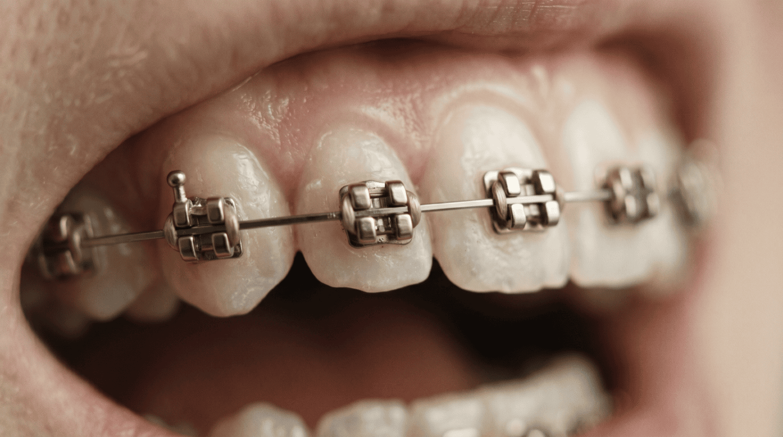 <em>Hawley retainer</em>: fördelar, nackdelar och vem den passar