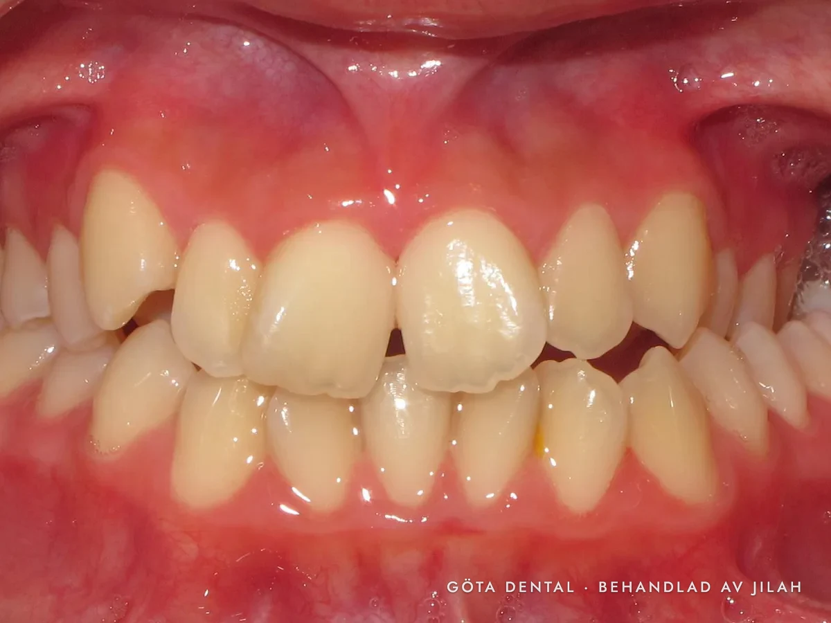 Före behandling, fall 03