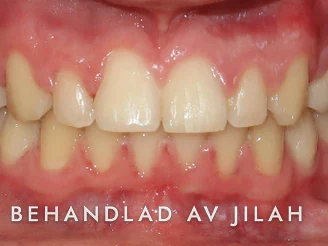 Efter behandling, fall 26