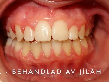 Efter behandling, fall 28