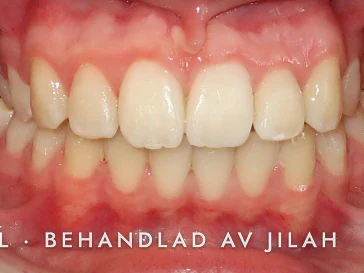 Efter behandling, fall 30