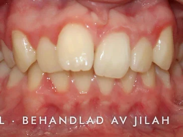Före behandling, fall 30