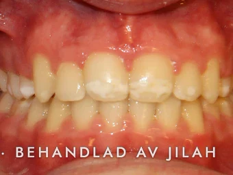 Efter behandling, fall 31