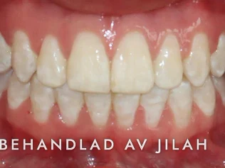Efter behandling, fall 35